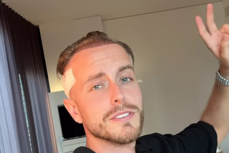 Julienco nach Haartransplantation in Wien