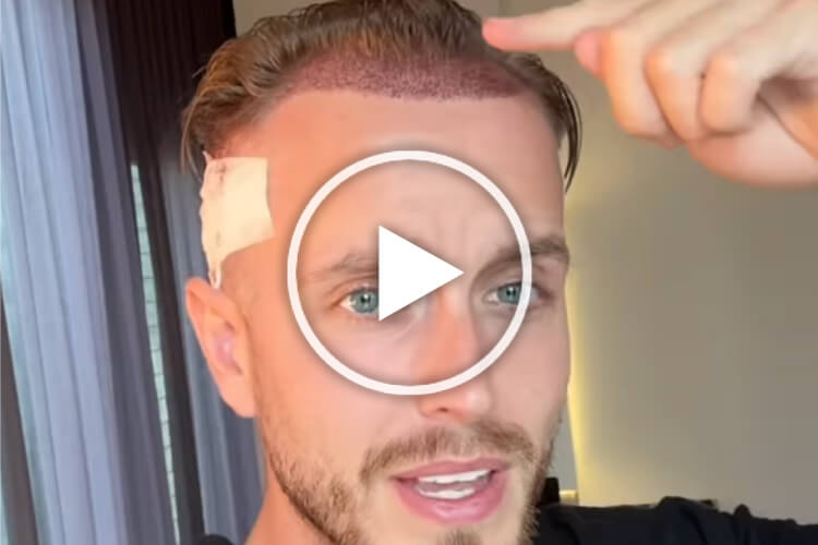 Bild zeigt Mann nach Haartransplantation